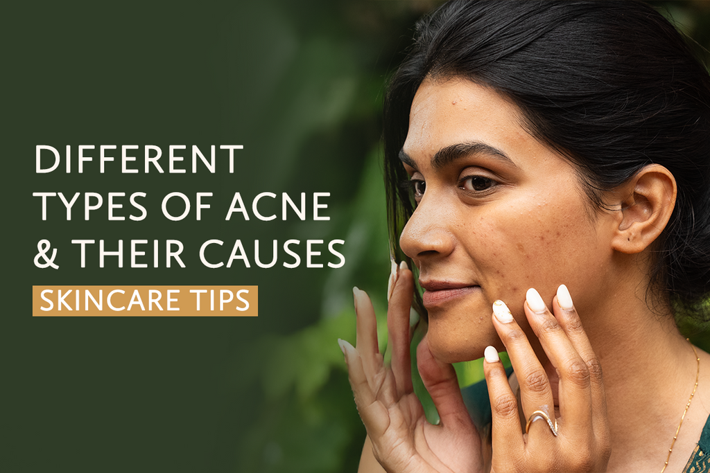 What are the different types of acne and their causes?